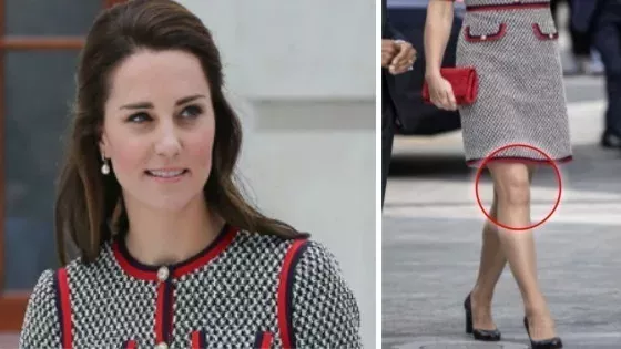Kate Middleton: Geistergesicht auf ihrem Knie?