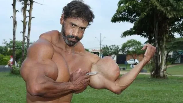 Valdir, der mit Synthol aufgeblasene, brasilianische "Bodybuilder", muss nun mit den Folgen seines Syntholmissbrauchs kämpfen! Echt abartig!