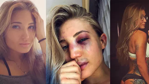 Anastasia Yankova zeigt ihr vom Kampf ramponiertes Gesicht
