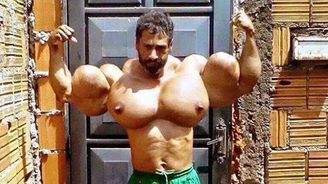 Valdir und seine mit Synthol aufgespritzten Muskeln machen Angst