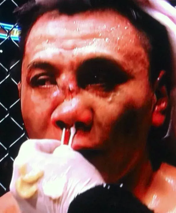 Das tut richtig weh: Die übelsten MMA-Verletzungen aller Zeiten!