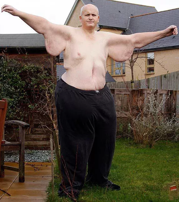 Der dickste Mann der Welt hat fast 300 Kilo abgenommen!