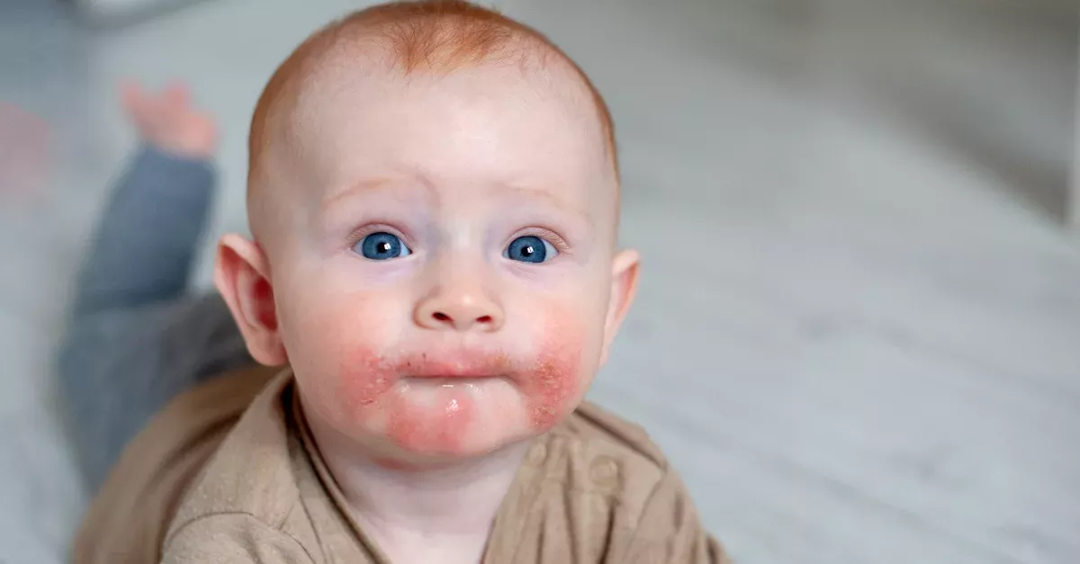 Atopische Dermatitis – Symptome, Ursachen, Therapie