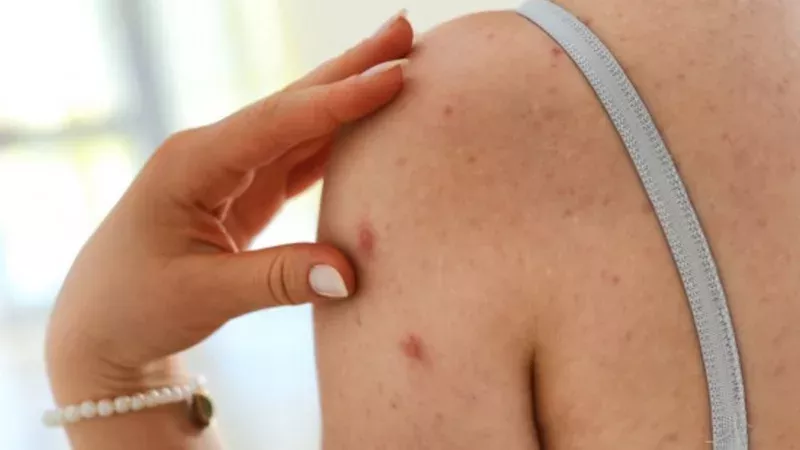Uni Dresden warnt: Studentin könnte Epidemie ausgelöst haben