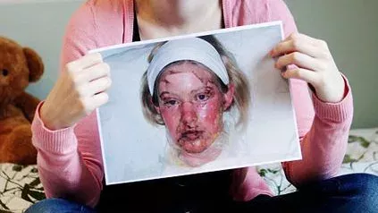 Lyell-Syndrom: Symptome, Ursachen, Behandlung