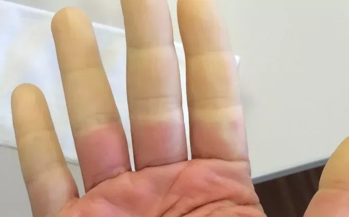 Raynaud-Syndrom: Symptome, Behandlung und Therapie