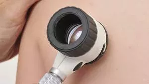 Angiom: Definition, Therapie und Behandlung, wie lässt es sich entfernen und was ist betroffen: Haut, Lippen, Gehirn und Leber?