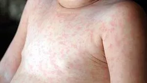 Drei-Tage-Fieber: Ausschlag, Symptome, wie lange ist es ansteckend?