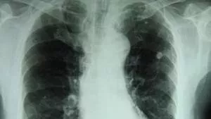Was ist Tuberkulose? Symptome, Impfung, Test, Ansteckung, Lungentubakulose/Knochentubakulose, Behandlung