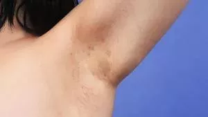 Acne inversa (Hidradrenitis): Therapie, Behandlung, Operation, Ursachen und Stadien