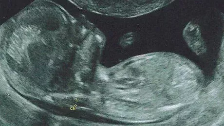 Down-Syndrom (Trisomie 21): Baby, Ursachen, Merkmale, Symptome, Lebenserwartung und Förderung