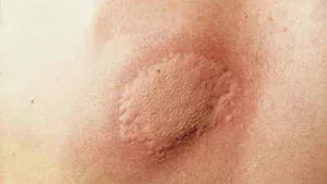 Nesselsucht: ist sie ansteckend? Behandlung, Hausmittel, Ursachen, Symptome und Dauer
