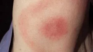 Lyme Borreliose: Symptome, Diagnose, Therapie, Behandlung, Erreger, was ist das überhaupt?