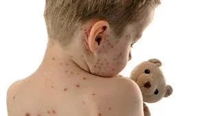 Masern: Symptome, Impfung, Inkubationszeit, Ansteckung, Erreger und Behandlung