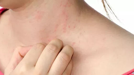 Ekzem: Die Formen Seborrhoisches Ekzem, Atopisches Ekzem, Konktaktekzem. Behandlung, Ursachen und Symtome