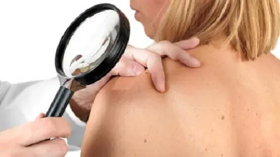 Lupus erythematodes: Was ist das? Symptome, Diagnose, Ursachen und Behandlung der Krankheit