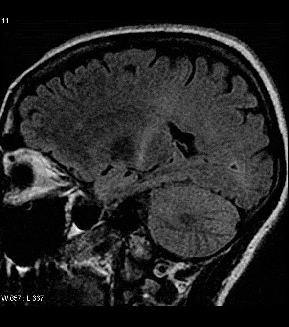 ALS Krankheit: Symptome, Lebenserwartung, Diagnose, Ursachen, was ist das?