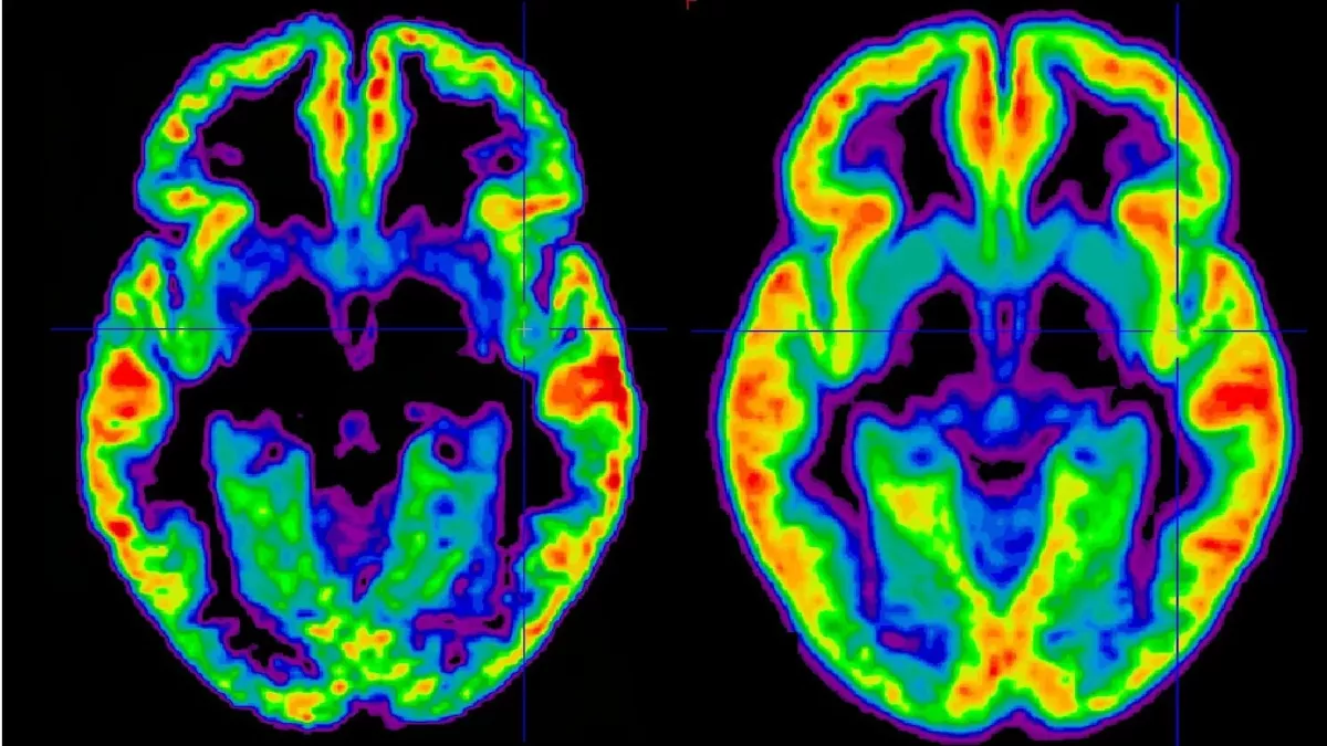 Schizophrenie: Definition, Symptome, Ursachen, Behandlung