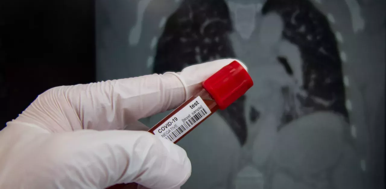 Neue Studie enthüllt: Covid-19 verursacht besorgniserregende Organschäden 