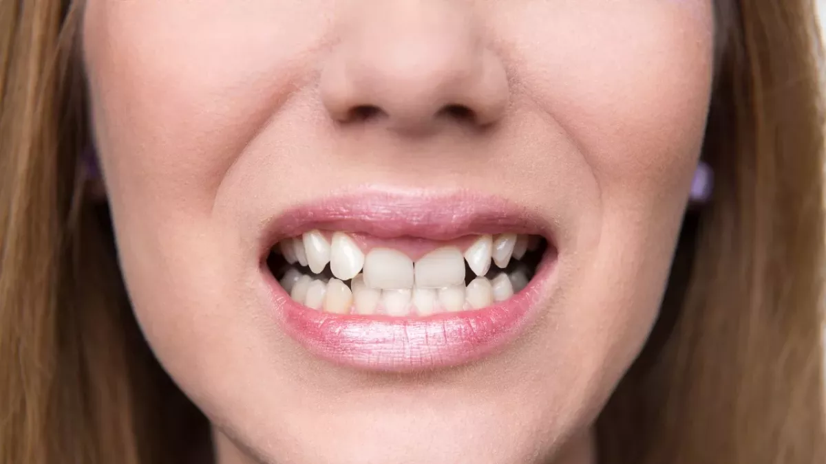 Schiefe Zähne: So wirken sie sich auf deine Gesundheit aus