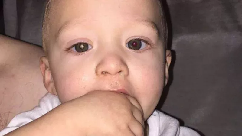 Der kleine Jaxson leidet an Augenkrebs