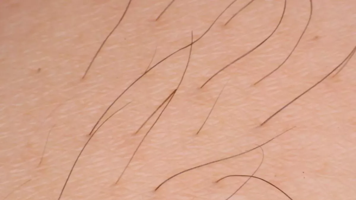 Eingewachsenes Haar wird zum Albtraum
