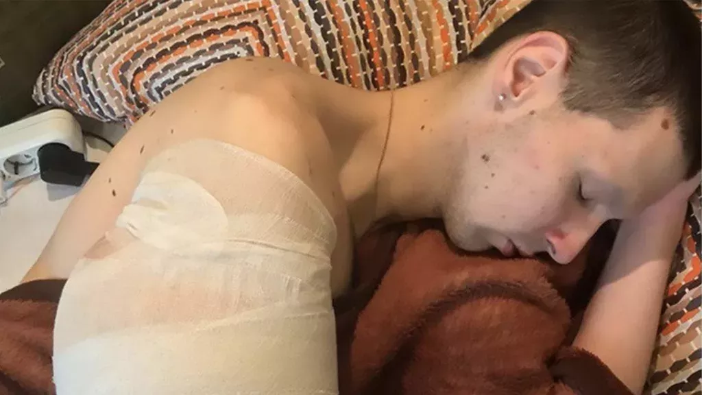 Synthol Kid lässt sich die Arme operieren und präsentiert das schockierende Ergebnis