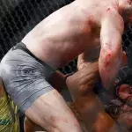 UFC: Alex Oliveiras präsentiert die riesige Narbe auf seiner Stirn