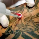 Tattoo-Entfernung per Laser