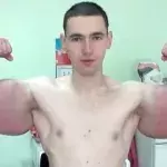 Russe spritzt sich Synthol in die Arme: Jetzt werden die Nebenwirkungen sichtbar
