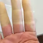 Raynaud-Syndrom: Symptome, Behandlung und Therapie