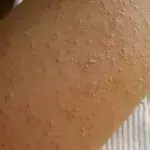 Glutenunverträglichkeit und ihre Symptome