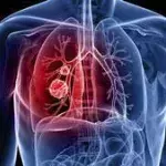 Lungenkrebs: Definition, Ursachen, Diagnose, Symptome und Anzeichen, Therapie und Behandlung, um was handelt es sich?