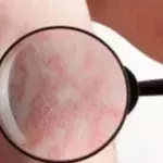 Schuppenflechte (Psoriasis): auf der Kopfhaut/Hand, Behandlung, Ernährung, Hausmittel und Symptome