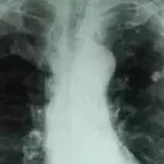Was ist Tuberkulose? Symptome, Impfung, Test, Ansteckung, Lungentubakulose/Knochentubakulose, Behandlung