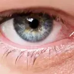 Was ist Grüner Star (Glaukom)? Definition, Symptome, Behandlung, OP, Ursachen und Therapie