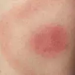 Lyme Borreliose: Symptome, Diagnose, Therapie, Behandlung, Erreger, was ist das überhaupt?
