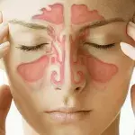 Sinusitis: Definition, Ethmoidalis/ Maxillaris/ Frontalis, Symptome, Hausmittel, Behandlung