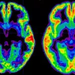 Schizophrenie: Definition, Symptome, Ursachen, Behandlung