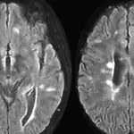 Multiple Sklerose (MS): Symptome, Anzeichen, Diagnose, Verlauf, Ursachen