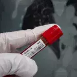 Neue Studie enthüllt: Covid-19 verursacht besorgniserregende Organschäden 