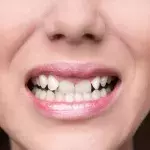 Schiefe Zähne: So wirken sie sich auf deine Gesundheit aus
