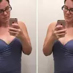 Bodyshaming nach Schönheits-OP