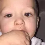Der kleine Jaxson leidet an Augenkrebs