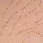 Eingewachsenes Haar wird zum Albtraum