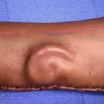 Sie pflanzen Ohr in den Arm ein
