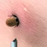 Zeckenbiss: Was tun?