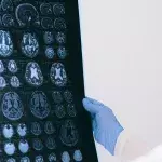 Fortschritt in der Demenzforschung: Forscher:innen machen wichtige Entdeckung