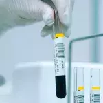 Ist die Behandlung mit Nabelschnurblut die Lösung im Kampf gegen HIV?