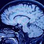 Schadet das Coronavirus auch unserem Gehirn?